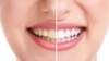 teeth whitining